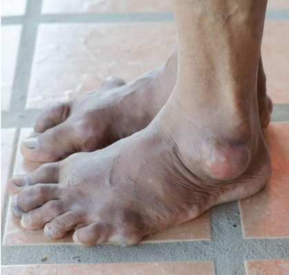 腳骨頭突出 (40) 