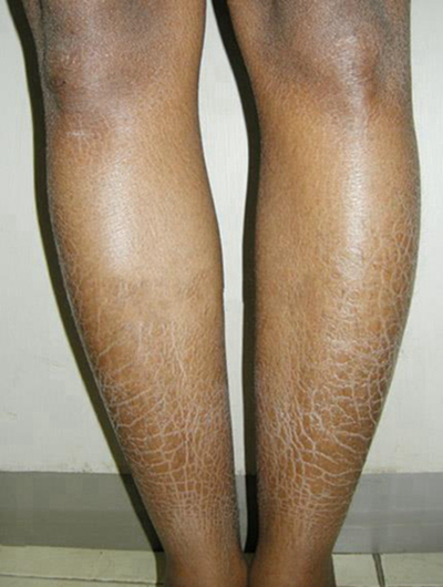 小腿皮膚像魚鱗 (44) 