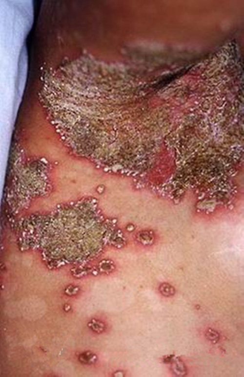 腋窩皰疹大皰性皮膚病