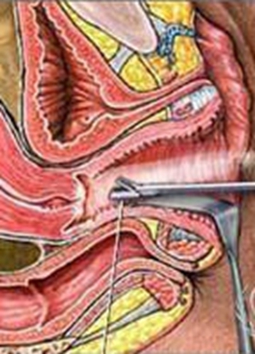 外陰潰瘍手術內部結構