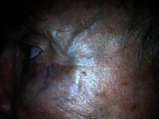 頸靜脈怒張 (45) 