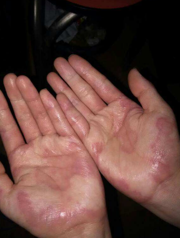 水皰型手癬