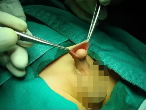 小兒尿道下裂術檢查