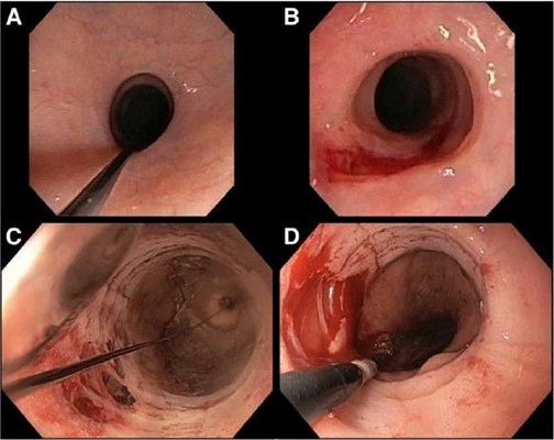 食道炎症狀 (32) 