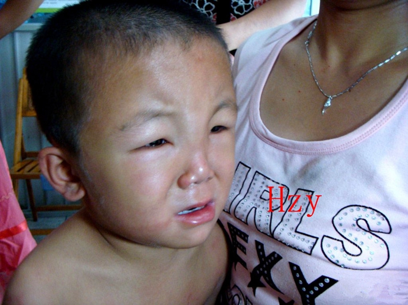 軀幹急疹瘙癢二天 