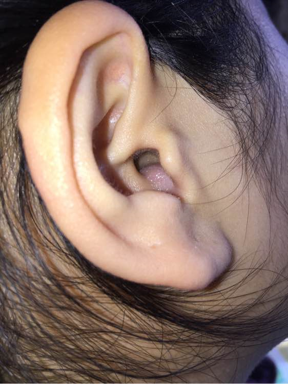 早期急性中耳炎