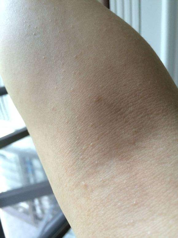 傳染性軟疣症狀及治療方法 