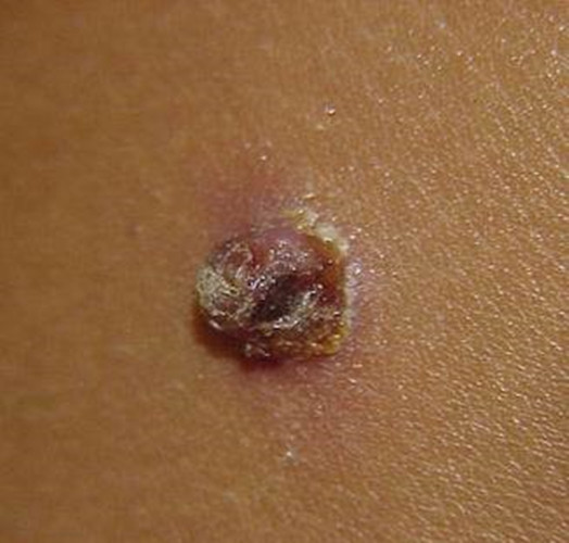 專治傳染性軟疣 