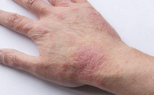 皮膚澱粉樣變 (50) 