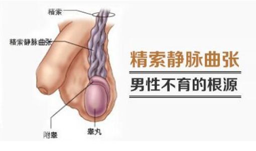 精索曲張睪丸下墜時