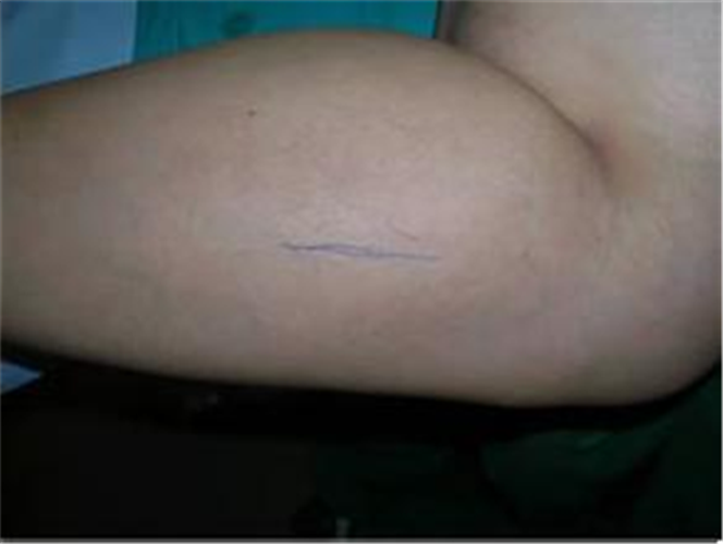 治療女惡性骨腫瘤