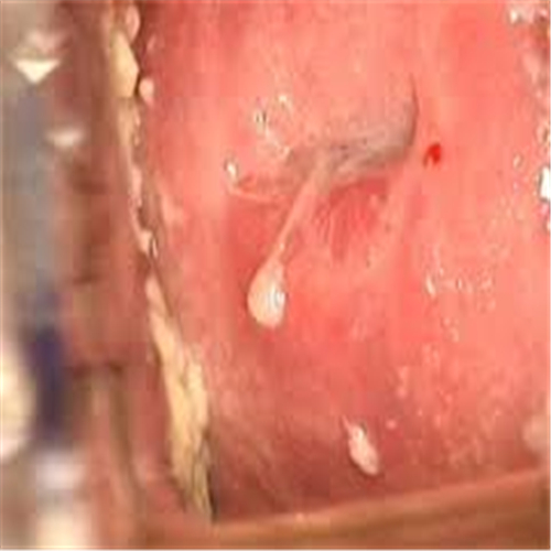 女性患外陰瘙癢後