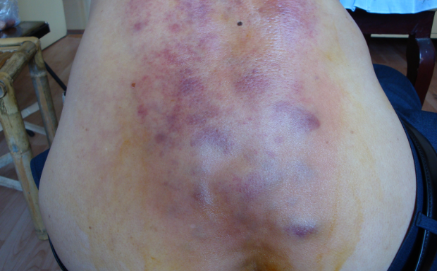 腰椎間盤突出症狀表現 (65) 