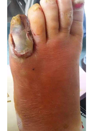 脈管炎早期症狀