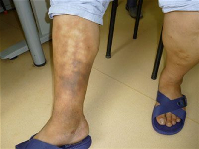 右小腿靜脈炎