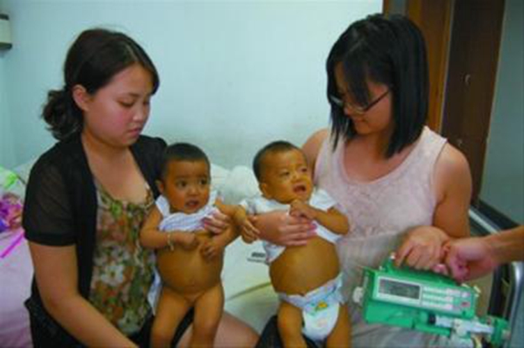 新生兒腹水症狀