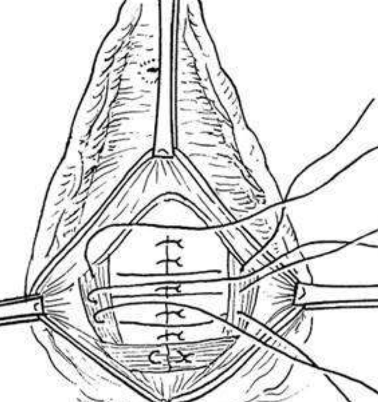 生孩子會陰撕裂的