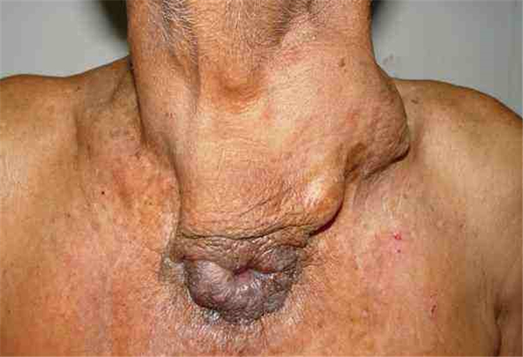 排膿的甲狀腺癌