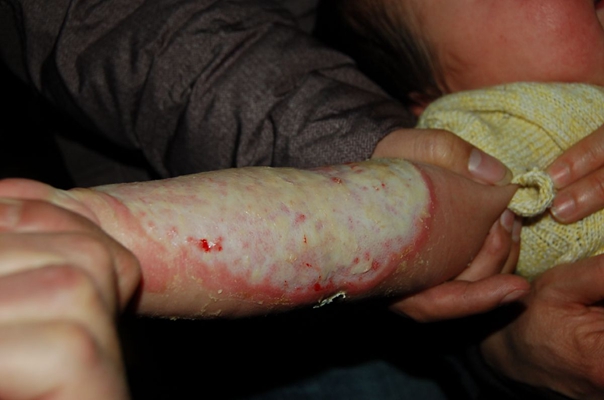 深二度燒傷 (35) 