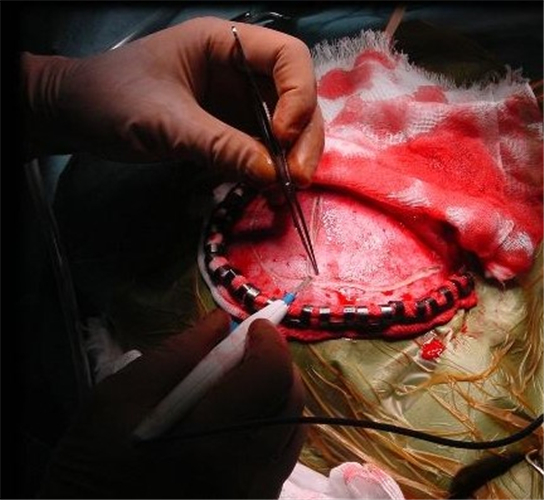 手術治療腦血管痙攣