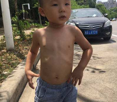 寶寶缺鈣雞胸圖 (6) 