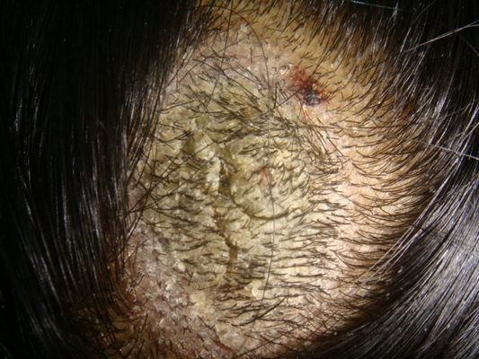 頭皮脂溢性皮炎 (48) 