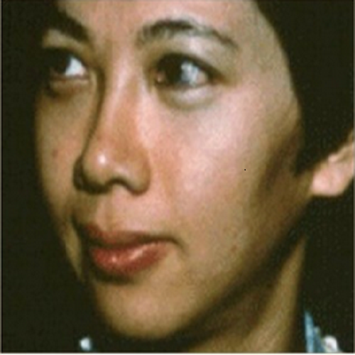 激光第二次太田痣