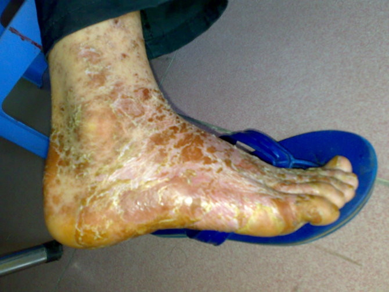 藥物性皮炎老年人剝脫性皮炎腳部