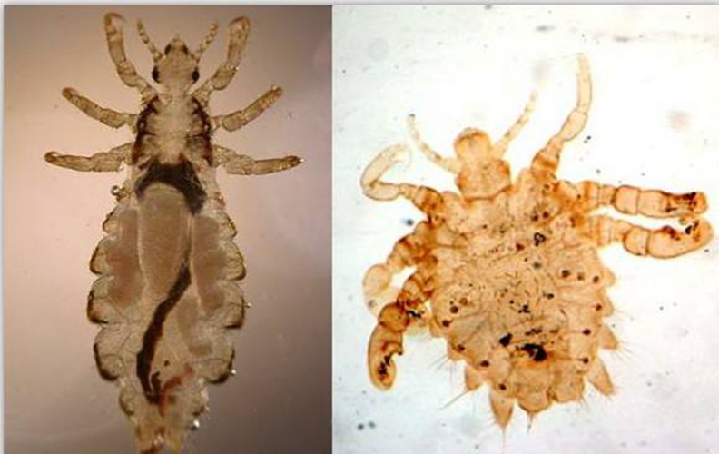 陰蝨病最佳的治療方法