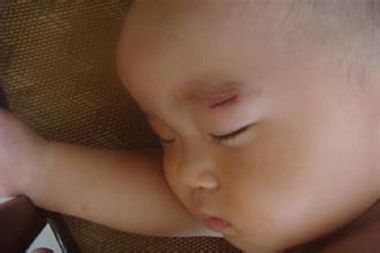 嬰兒眉毛破傷風傷口