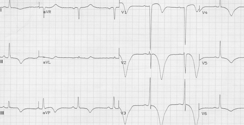 房顫心電圖特點 (9) 