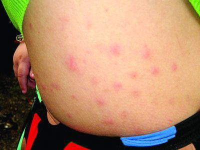 被跳蚤咬的症狀