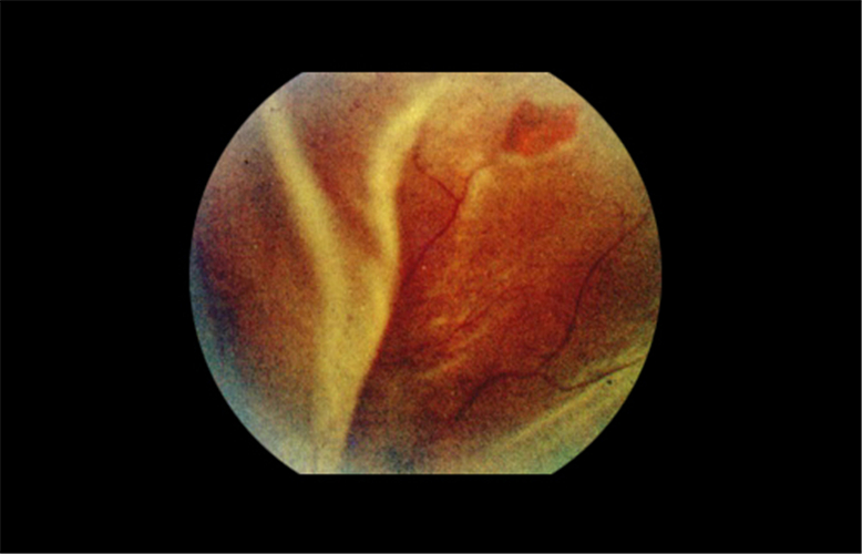 原發性視網膜脫落眼底