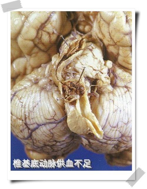 椎基底動脈供血不足腦梗塞