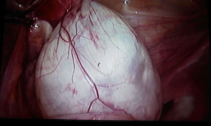 右卵巢巧克力囊腫