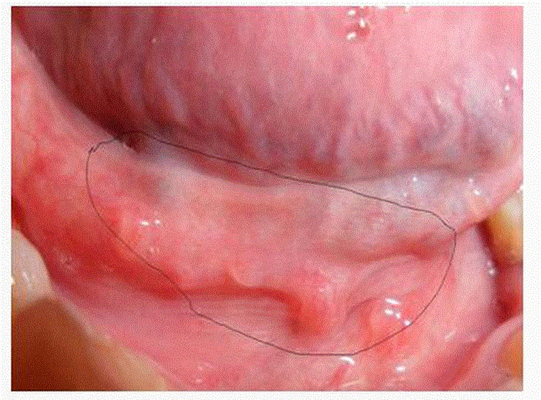 淋病的症狀 (50) 
