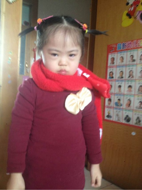 小兒唐氏綜合徵 