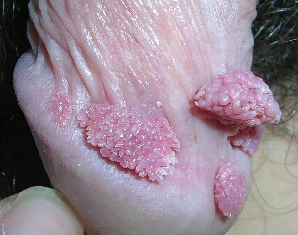 男性尖銳溼疣照片 (39) 