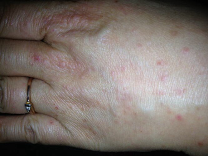 阿姨手部溼疹的