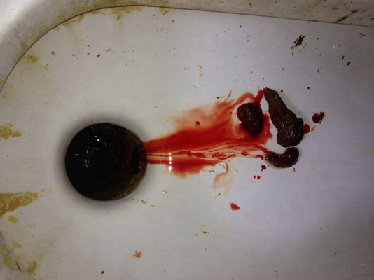 結腸癌症狀 (49) 