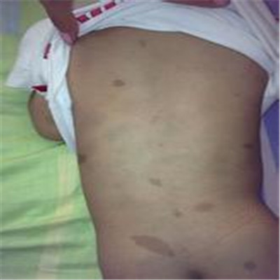 牛奶咖啡斑 (45) 