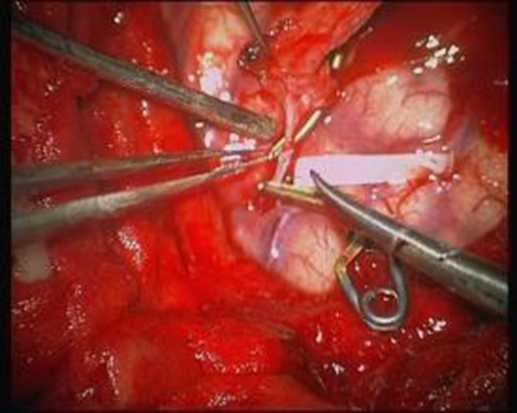 煙霧病幼兒頭部