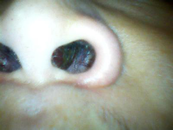 萎縮性慢性鼻炎