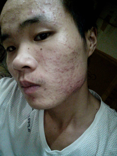 血熱的症狀痘痘