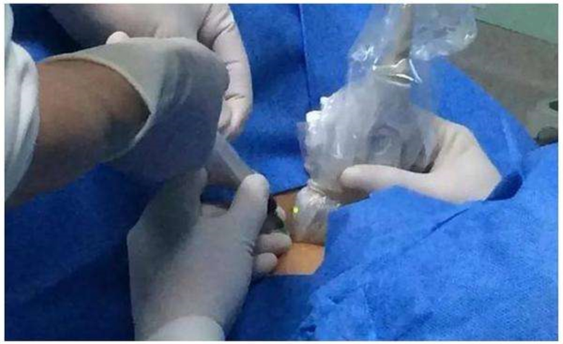 微創消融術治療甲狀腺結節