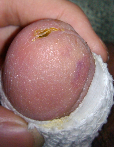 黴菌性龜頭炎 (43) 