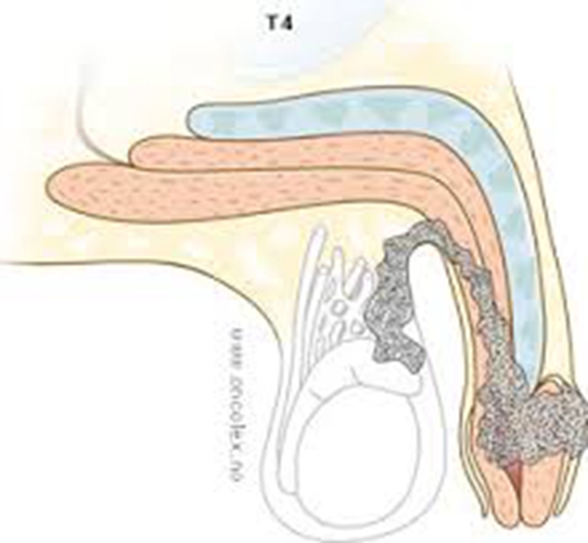 早期陰莖癌圖例解析