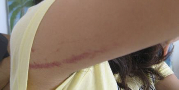 系統性紅斑狼瘡診斷標準 (46) 