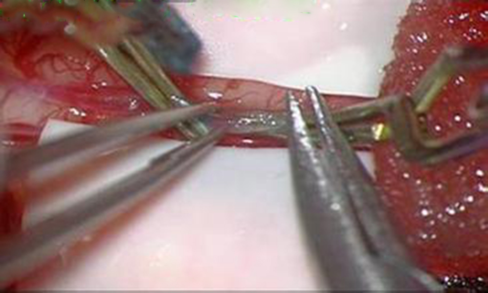 煙霧病造影表現