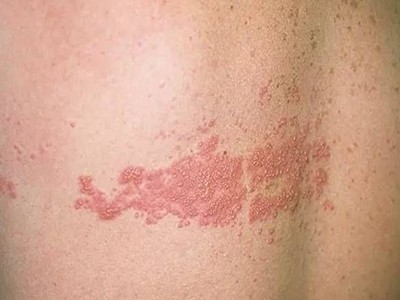 性病性淋巴肉芽腫套圖 (55) 